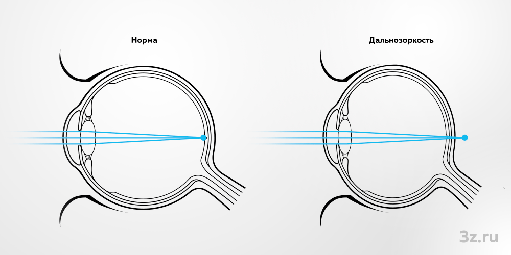 Расположение оптического фокуса изображения при нормальном зрении и при дальнозоркости