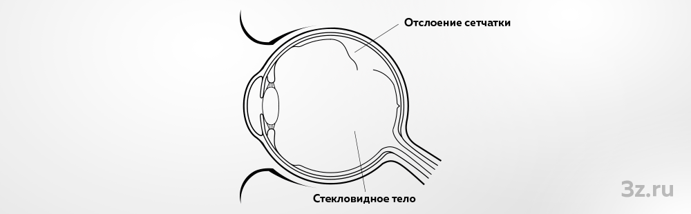 Операция при отслоении сетчатки глаза в перми