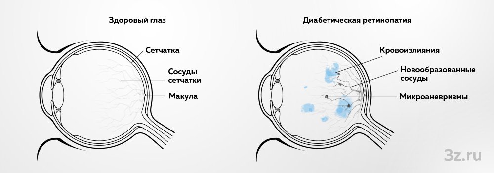 Ранние признаки диабета 2 типа, которые чаще всего игнорируют