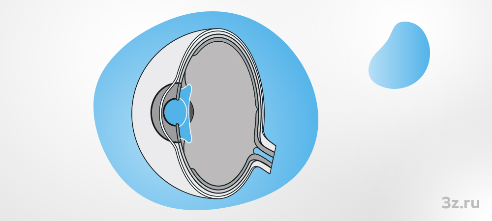 Памятка при имплантации ФИОЛ и пресбиФИОЛ — 3Z